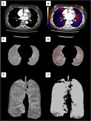 Quantification of pulmonary perfusion using LSIM-CT correlates with pulmonary hemodynamics in patients with CTEPD